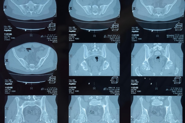 MRI de la articulación sacroiliar Estudio de un paciente con espondiloartritis anquilosante