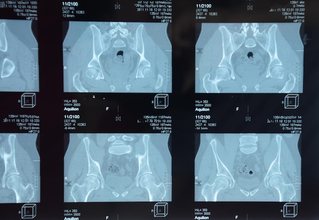 Foto mri de la articulación sacroiliar estudio de un paciente con espondiloartritis anquilosante