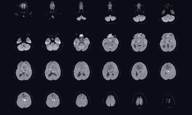 MRI BRAIN Befund eines Meningeoms, das von der vorderen Falx cerebri ausgeht und sich auf bilaterale Frontalregionen mit angrenzendem minimalem periläsionalem Ödem am linken Frontallappen erstreckt Medizinisches Bildkonzept