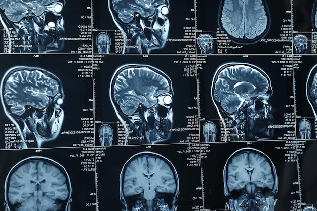 MRI ou ressonância magnética da cabeça e do cérebro