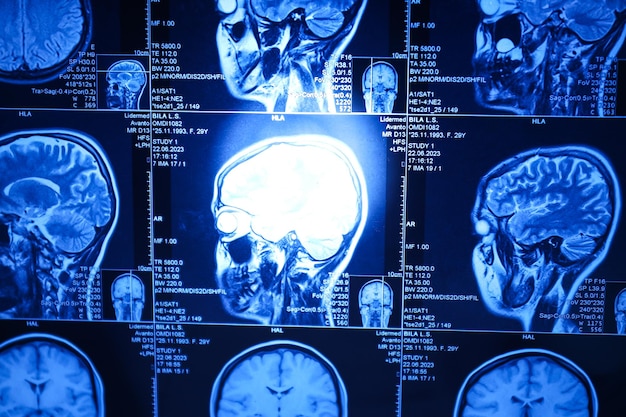 MRI ou ressonância magnética da cabeça e do cérebro
