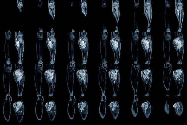 MRT-Scan der unteren Extremität beider Beine mit Tumor oder Masse an der WadeMedizinisches Technologiekonzept