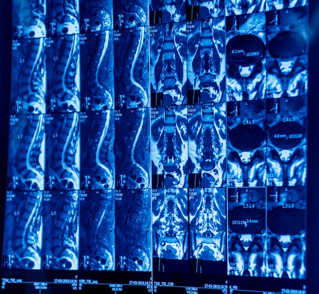 MRT-Scan der Wirbelsäule eines Patienten mit chronischen Rückenschmerzen.