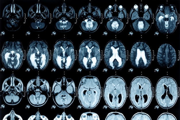 Mrt-scan oder magnetresonanz-bild des gehirns zeigte einen obstruktiven triventrikulären hydrozephalus. medizinisches servicekonzept.