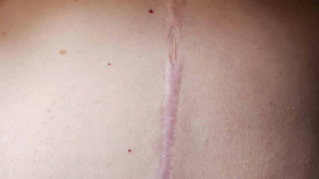Mucho tiempo después de la cicatriz de la cirugía en el abdomen femenino por encima del ombligo