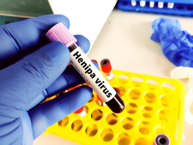 Muestra biológica de sangre en tubo de vacío para análisis patológico Pruebas de laboratorio médico