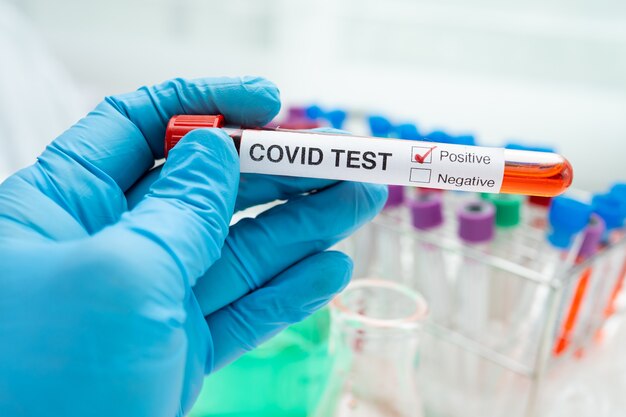Muestra de infección de sangre positiva en tubo de ensayo para coronavirus covid19