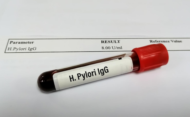 Foto muestra de sangre aislada para la prueba de h pylori igg con informe de paciente anormal alto