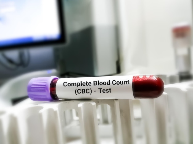 Muestra de sangre para CBC o prueba de conteo sanguíneo completo. Análisis hematológico.