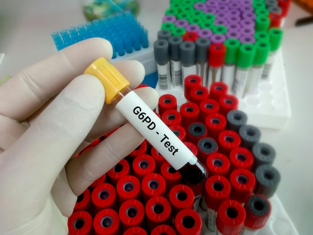 Foto muestra de sangre para g6pd o prueba de glucosa 6 fosfato deshidrogenasa