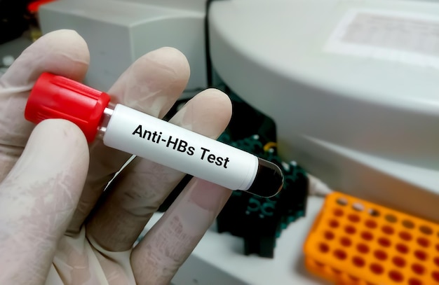 Muestra de sangre para prueba anti HBs o prueba de anticuerpos de superficie de hepatitis B