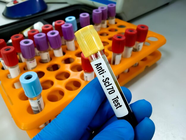 Muestra de sangre para prueba Anti Scl70 (Scleroma 70), diagnóstico de trastornos autoinmunes, prueba sistémica.