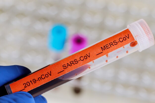Foto muestra de sangre para prueba de coronavirus
