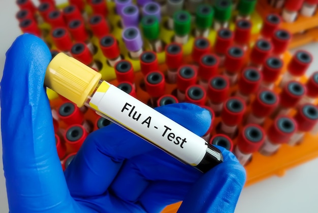 Muestra de sangre para la prueba de gripe A. virus de la gripe.