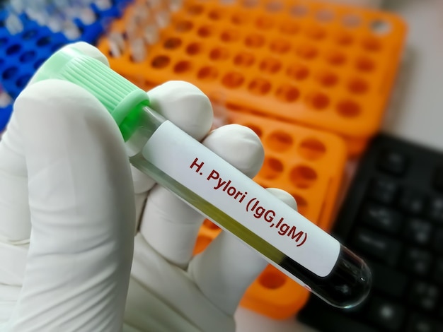 Muestra de sangre para la prueba de H Pylori o Helicobacter pylori IgG e IgM