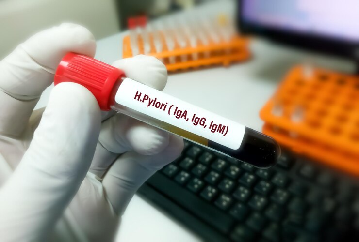 Foto muestra de sangre para la prueba de h pylori que incluye iga igg e igm