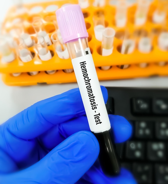 Muestra de sangre para la prueba de hemocromatosis, un trastorno en el que el cuerpo puede acumular demasiado hierro