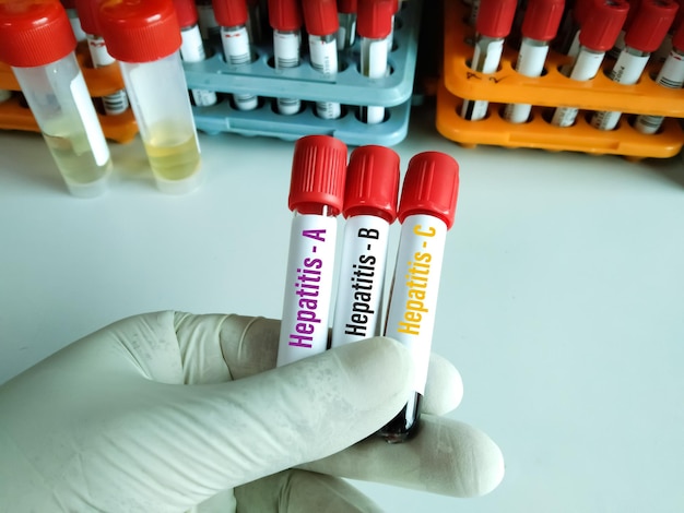 Muestra de sangre para prueba de Hepatitis A, B y C con kit de prueba rápida. Mostrando resultado positivo. prueba de hígado