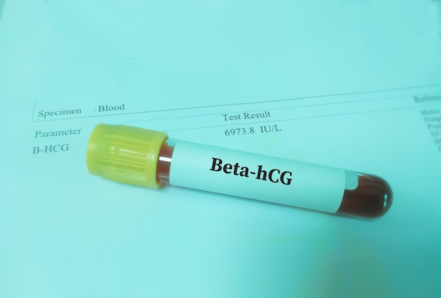 Muestra de sangre para la prueba de la hormona Beta hCG con resultado
