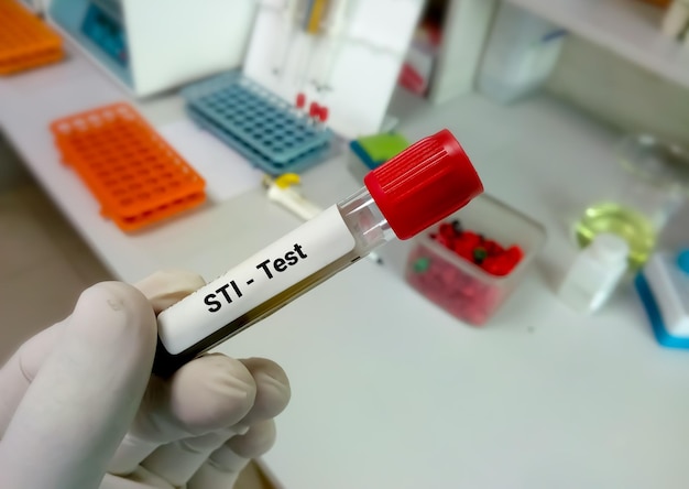 Muestra de sangre para prueba de ITS o Infecciones de transmisión sexual