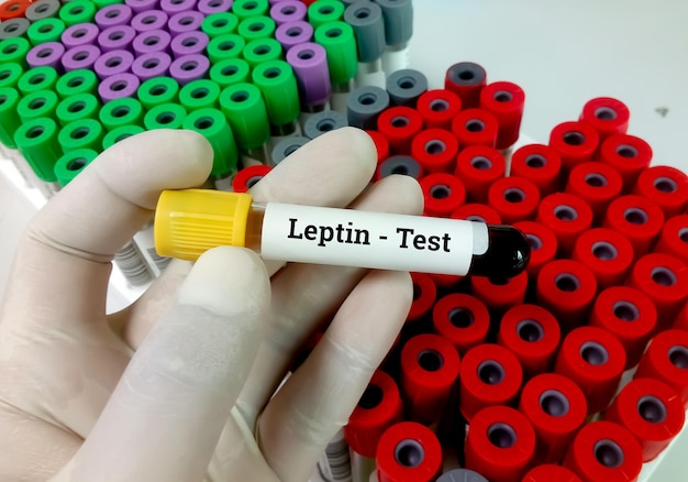 Muestra de sangre para la prueba de leptina para diagnosticar pruebas de obesidad