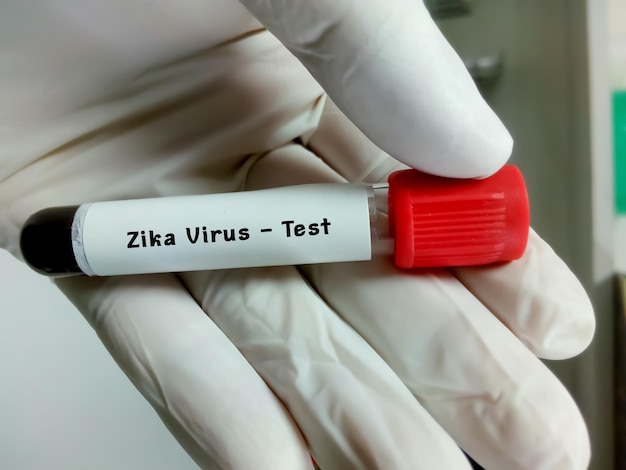 Muestra de sangre para la prueba del virus Zika