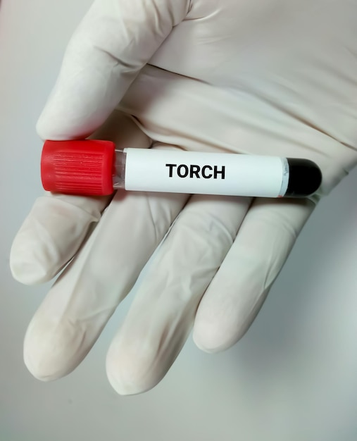 Muestra de sangre para test TORCH o Panel TORCH