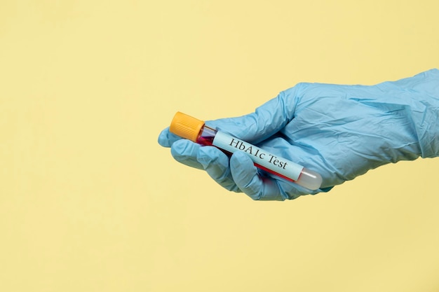 Foto muestra de sangre en un tubo de vacío para el diagnóstico de diabetes con prueba de hemoglobina hba1c