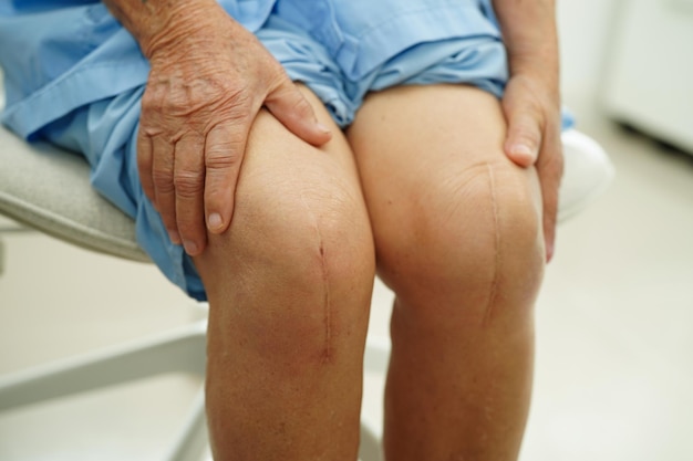 Foto mujer anciana asiática paciente con cirugía de reemplazo de rodilla con cicatriz en el hospital