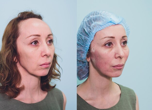 Foto mujer anciana haciendo mesothreads y thread lifting cosmetología procedimiento cosmético para eliminar signos de envejecimiento belleza cara contorno facial concepto de cirugía plástica para la edad 4050 años