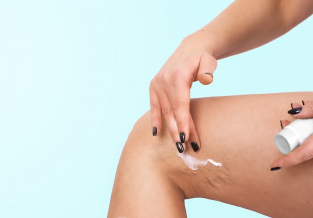 Mujer aplicando crema en venas varicosas problema de medicina de salud de piernas
