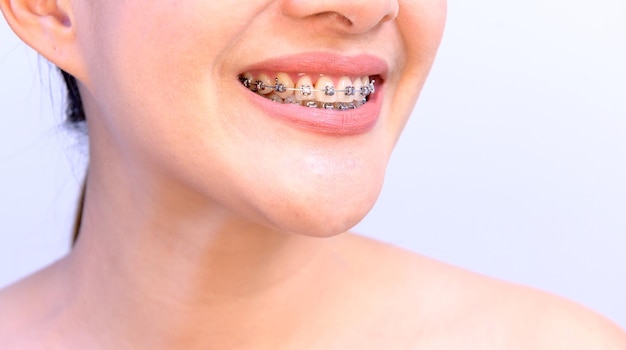 Mujer asiática sonriente con retenedor de ortodoncia. Cuidado dental y dientes sanos.