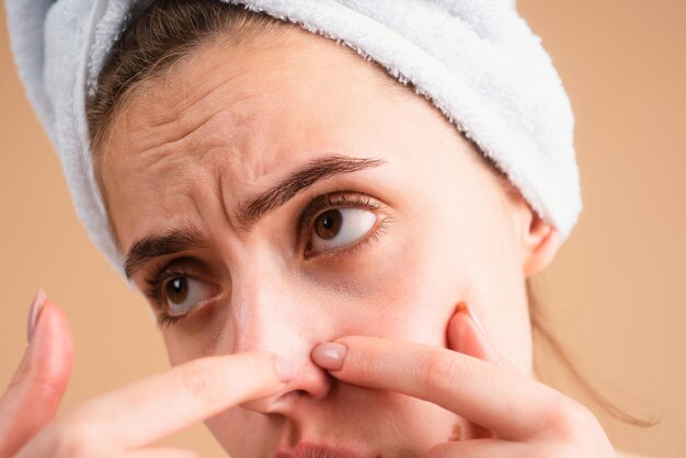 Mujer de cerca cara apretando espinillas acné mancha manchas piel en mujer joven mancha cicatriz acné pecas