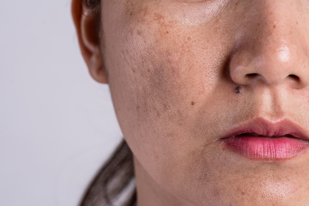 Foto mujer con cicatrices problemáticas de piel y acné. concepto de problema de cuidado de la piel.