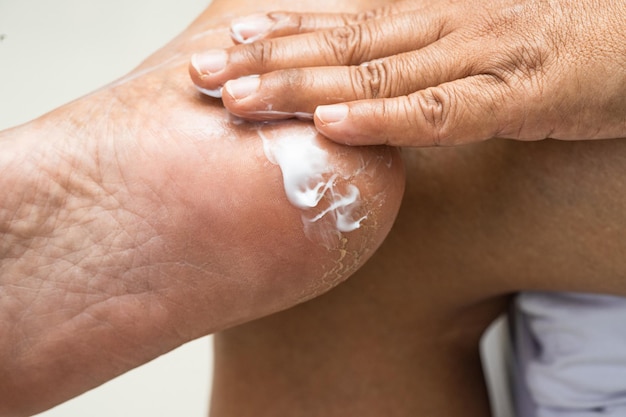 La mujer cuida los pies con crema para la piel del talón agrietada y seca en casa