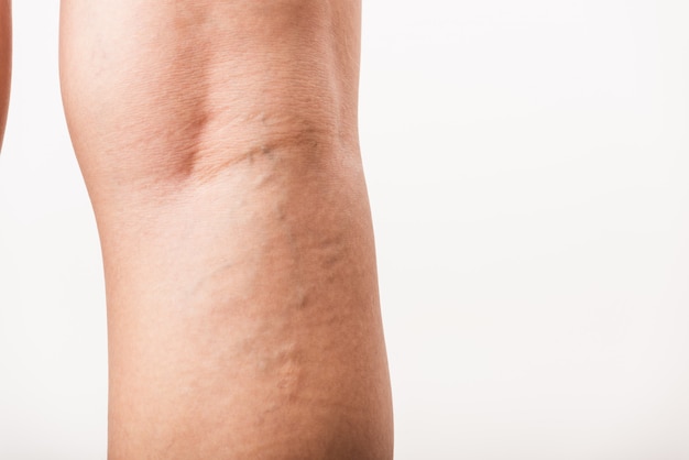 Mujer dolorosas varices y arañas vasculares en la pierna