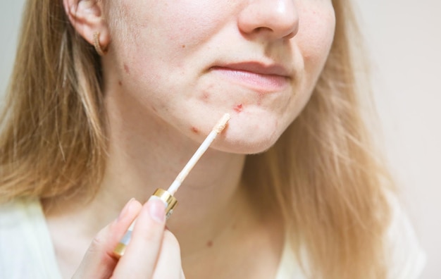 La mujer está cubriendo el acné con corrector Maquillaje para pieles grasas con problemas