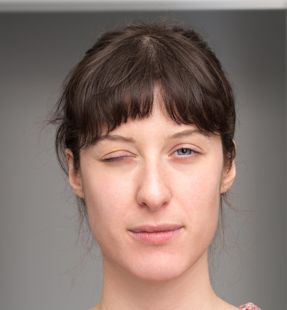 Mujer con hemiparesia facial