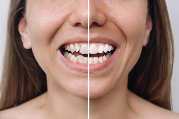 Mujer joven antes y después de la instalación de carillas Corrección de dientes irregulares con frenos Comparación