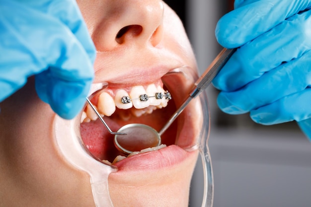 Una mujer joven con aparatos metálicos está siendo examinada por un ortodoncista que corrige la mordedura de los dientes