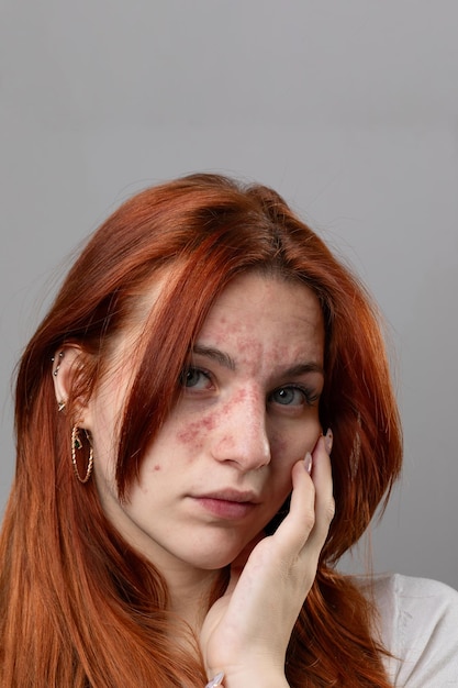 Foto mujer joven con erupción cutánea aguda en la cara problemas dermatológicos debido a hipersensibilidad alérgica o shock anafiláctico piel enrojecida con erupción o eccema