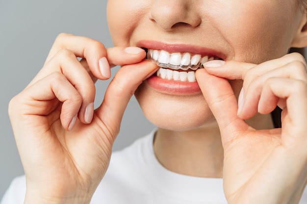 Foto una mujer joven hace un procedimiento de blanqueamiento de dientes en casa bandeja de blanqueamiento con gel