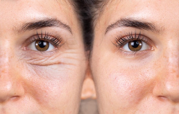 Foto una mujer joven muestra los resultados antes y después de una exitosa cirugía de blefaroplastia