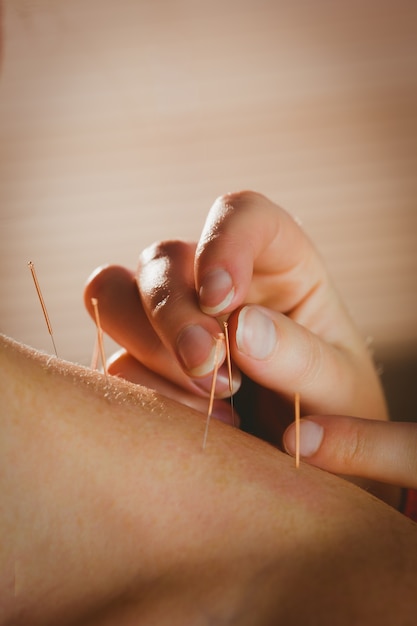 Mujer joven recibiendo tratamiento de acupuntura