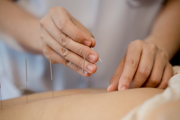 Mujer joven en tratamiento de acupuntura