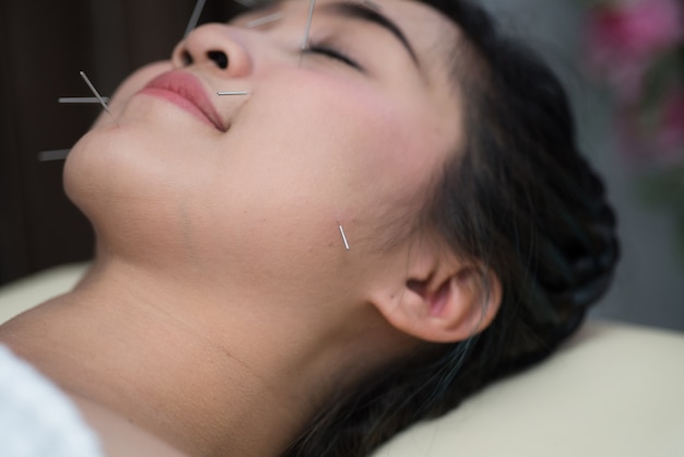 Mujer joven en tratamiento de acupuntura