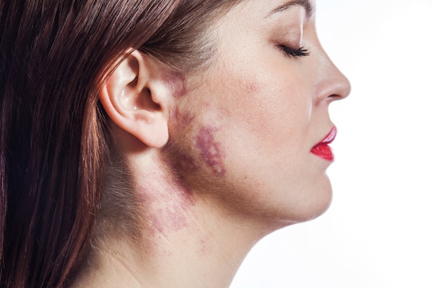 Mujer con marca de nacimiento de mancha de vino de Oporto real en su rostro