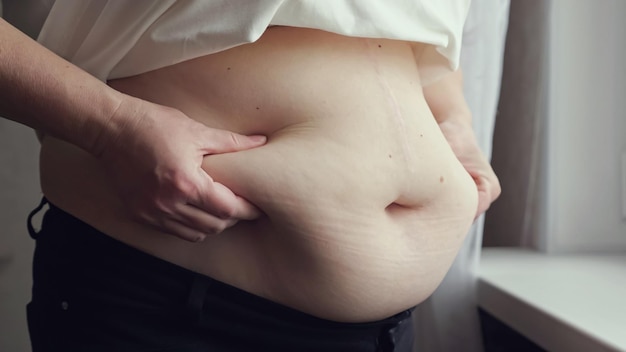 La mujer mayor comprime la piel del abdomen comprobando el exceso de grasa