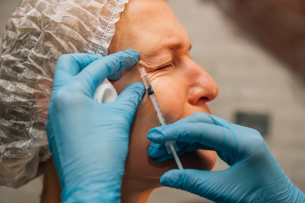 Mujer de mediana edad con arrugas en patas de gallo alrededor de los ojos sometida a un procedimiento de rejuvenecimiento con inyecciones de relleno de ácido hialurónico