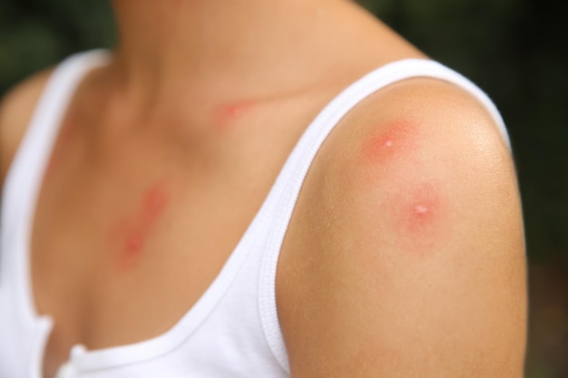 Foto mujer con picaduras de insectos en el cuerpo al aire libre vista de cerca